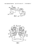 Arthroplasy Revision System and Method diagram and image