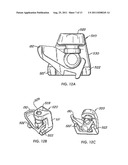 Arthroplasy Revision System and Method diagram and image