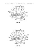 Arthroplasy Revision System and Method diagram and image