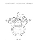 Arthroplasy Revision System and Method diagram and image