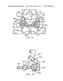 Arthroplasy Revision System and Method diagram and image