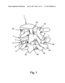 Spinal Facet Implant with Spherical Implant Apposition Surface and Bone     Bed and Methods of Use diagram and image