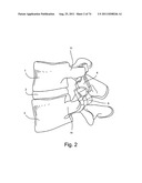 Spinal Facet Implant with Spherical Implant Apposition Surface and Bone     Bed and Methods of Use diagram and image