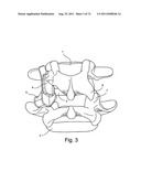 Spinal Facet Implant with Spherical Implant Apposition Surface and Bone     Bed and Methods of Use diagram and image