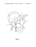 Spinal Facet Implant with Spherical Implant Apposition Surface and Bone     Bed and Methods of Use diagram and image