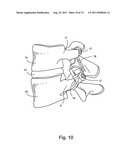 Spinal Facet Implant with Spherical Implant Apposition Surface and Bone     Bed and Methods of Use diagram and image