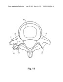 Spinal Facet Implant with Spherical Implant Apposition Surface and Bone     Bed and Methods of Use diagram and image