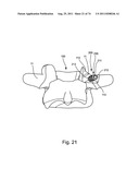 Spinal Facet Implant with Spherical Implant Apposition Surface and Bone     Bed and Methods of Use diagram and image