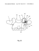 Spinal Facet Implant with Spherical Implant Apposition Surface and Bone     Bed and Methods of Use diagram and image