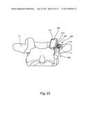 Spinal Facet Implant with Spherical Implant Apposition Surface and Bone     Bed and Methods of Use diagram and image