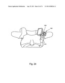 Spinal Facet Implant with Spherical Implant Apposition Surface and Bone     Bed and Methods of Use diagram and image