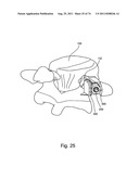 Spinal Facet Implant with Spherical Implant Apposition Surface and Bone     Bed and Methods of Use diagram and image