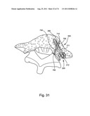 Spinal Facet Implant with Spherical Implant Apposition Surface and Bone     Bed and Methods of Use diagram and image