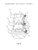 Spinal Facet Implant with Spherical Implant Apposition Surface and Bone     Bed and Methods of Use diagram and image