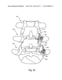 Spinal Facet Implant with Spherical Implant Apposition Surface and Bone     Bed and Methods of Use diagram and image