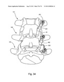 Spinal Facet Implant with Spherical Implant Apposition Surface and Bone     Bed and Methods of Use diagram and image