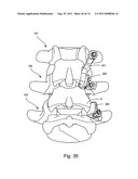 Spinal Facet Implant with Spherical Implant Apposition Surface and Bone     Bed and Methods of Use diagram and image