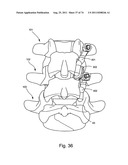 Spinal Facet Implant with Spherical Implant Apposition Surface and Bone     Bed and Methods of Use diagram and image