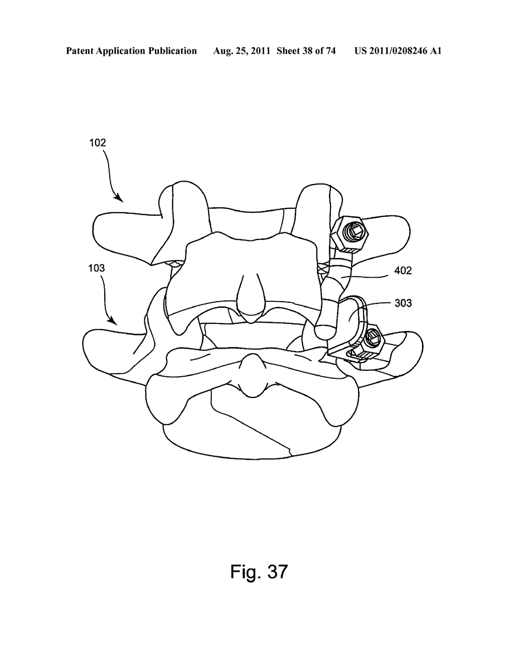 Spinal Facet Implant with Spherical Implant Apposition Surface and Bone     Bed and Methods of Use - diagram, schematic, and image 39