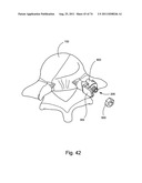 Spinal Facet Implant with Spherical Implant Apposition Surface and Bone     Bed and Methods of Use diagram and image