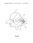 Spinal Facet Implant with Spherical Implant Apposition Surface and Bone     Bed and Methods of Use diagram and image