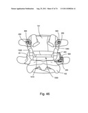 Spinal Facet Implant with Spherical Implant Apposition Surface and Bone     Bed and Methods of Use diagram and image