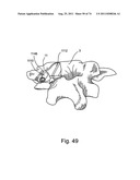 Spinal Facet Implant with Spherical Implant Apposition Surface and Bone     Bed and Methods of Use diagram and image