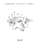 Spinal Facet Implant with Spherical Implant Apposition Surface and Bone     Bed and Methods of Use diagram and image