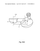 Spinal Facet Implant with Spherical Implant Apposition Surface and Bone     Bed and Methods of Use diagram and image