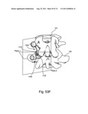 Spinal Facet Implant with Spherical Implant Apposition Surface and Bone     Bed and Methods of Use diagram and image