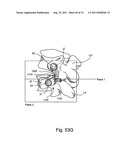 Spinal Facet Implant with Spherical Implant Apposition Surface and Bone     Bed and Methods of Use diagram and image