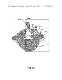 Spinal Facet Implant with Spherical Implant Apposition Surface and Bone     Bed and Methods of Use diagram and image