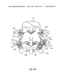 Spinal Facet Implant with Spherical Implant Apposition Surface and Bone     Bed and Methods of Use diagram and image