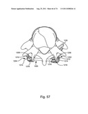 Spinal Facet Implant with Spherical Implant Apposition Surface and Bone     Bed and Methods of Use diagram and image