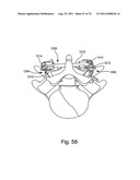 Spinal Facet Implant with Spherical Implant Apposition Surface and Bone     Bed and Methods of Use diagram and image