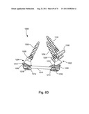 Spinal Facet Implant with Spherical Implant Apposition Surface and Bone     Bed and Methods of Use diagram and image