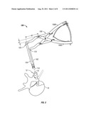 MINIMALLY INVASIVE METHOD AND INSTRUMENT FOR THE REDUCTION OF A ROD INTO     POSITION IN A PEDICLE SCREW diagram and image