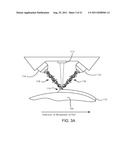 Laser Based Metal Deposition LBMD of Antimicrobials to Implant Surfaces diagram and image