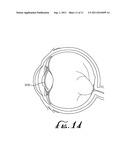 SYSTEM FOR FORMING AND MODIFYING LENSES AND LENSES FORMED THEREBY diagram and image