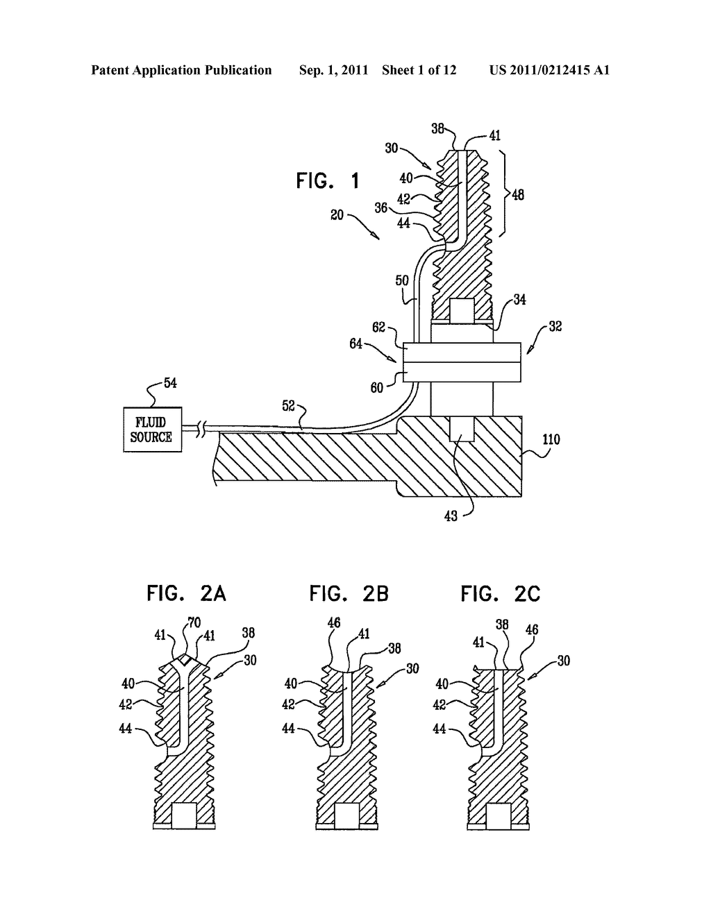 SINUS LIFT IMPLANT - diagram, schematic, and image 02