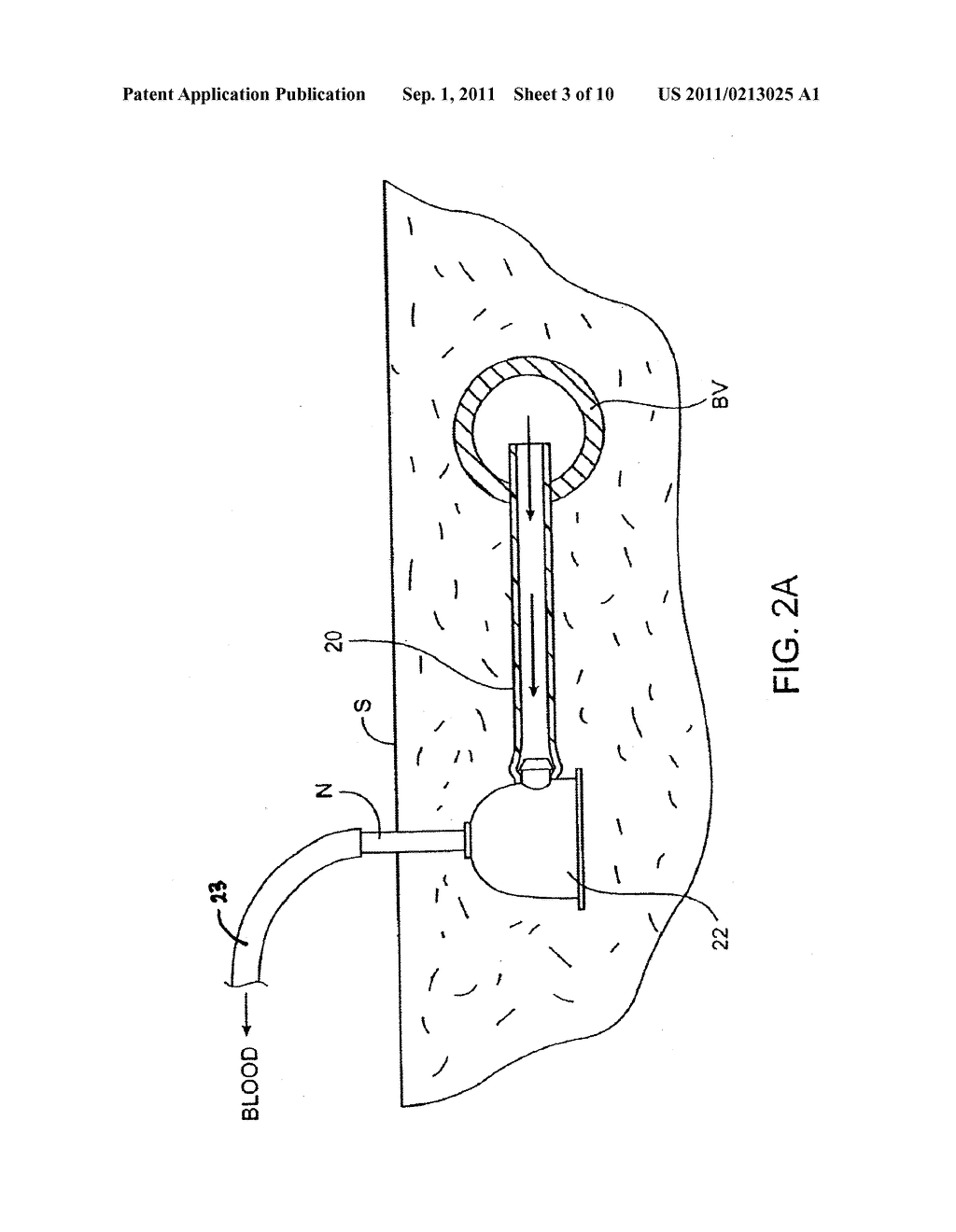 Catheter Lock Solutions Utilizing Tocopherol and Mid-Chain Fatty Acids - diagram, schematic, and image 04