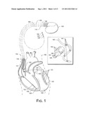 CRT LEAD PLACEMENT BASED ON OPTIMAL BRANCH SELECTION AND OPTIMAL SITE     SELECTION diagram and image