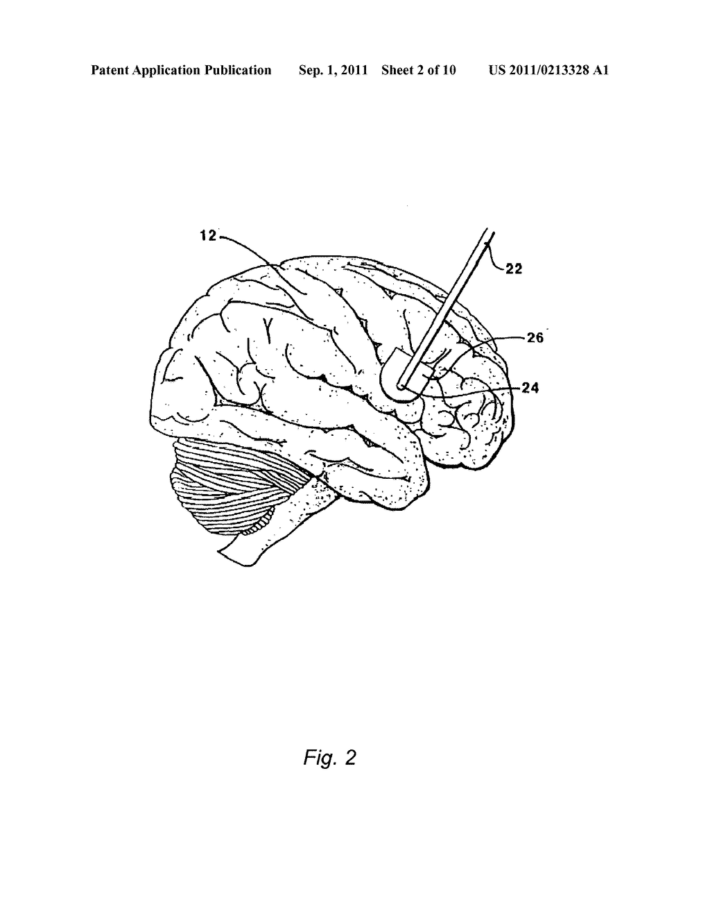 Methods and Systems for Treatment of Neurological Diseases of the Central     Nervous System - diagram, schematic, and image 03