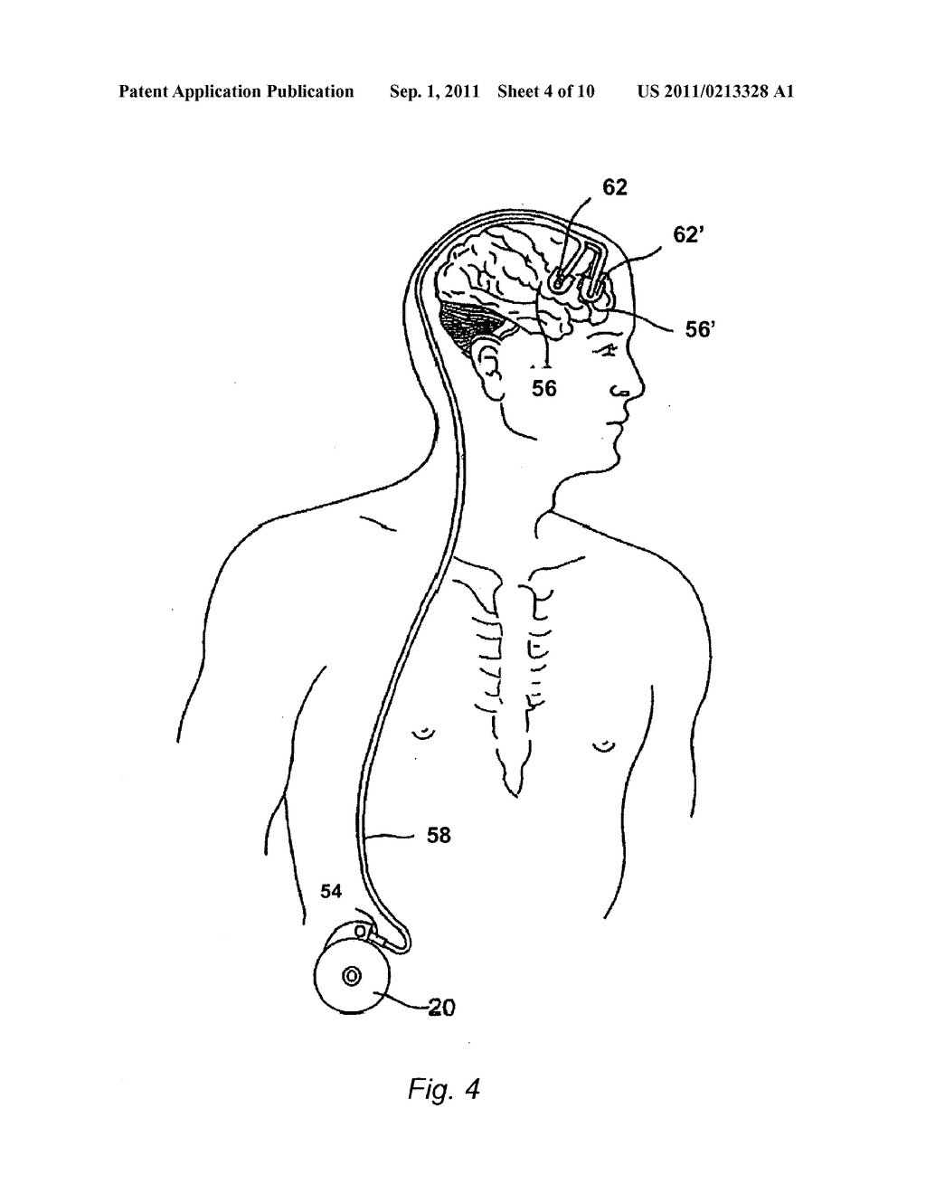 Methods and Systems for Treatment of Neurological Diseases of the Central     Nervous System - diagram, schematic, and image 05