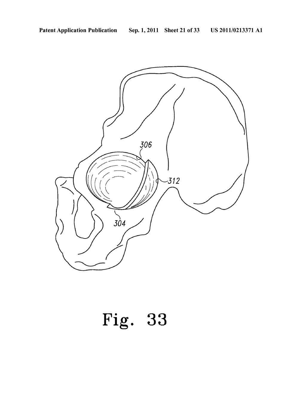 RECIPROCATING RASPS FOR USE IN AN ORTHOPAEDIC SURGICAL PROCEDURE - diagram, schematic, and image 22