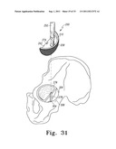 RECIPROCATING RASPS FOR USE IN AN ORTHOPAEDIC SURGICAL PROCEDURE diagram and image