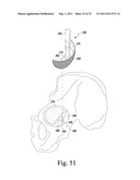 RECIPROCATING RASPS FOR USE IN AN ORTHOPAEDIC SURGICAL PROCEDURE diagram and image