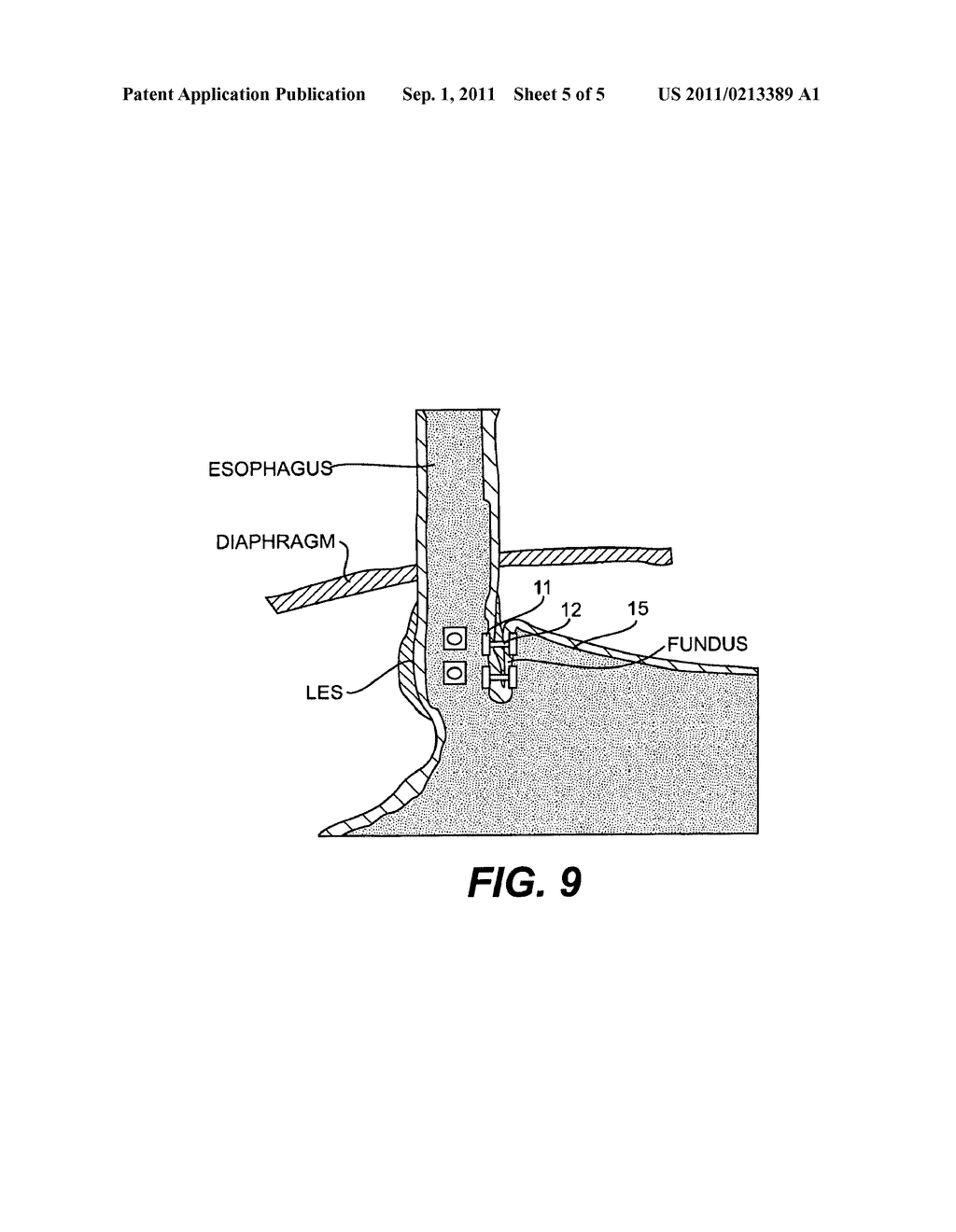 DEVICES AND RELATED METHODS FOR SECURING A TISSUE FOLD - diagram, schematic, and image 06