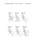 TRANSORAL ENDOSCOPIC GASTROESOPHAGEAL FLAP VALVE RESTORATION DEVICE,     ASSEMBLY, SYSTEM AND METHOD diagram and image