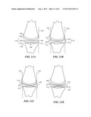 Patient Selectable Joint Arthroplasty Devices and Surgical Tools diagram and image